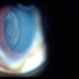 Ciliary body melanoma Ciliary body melanoma